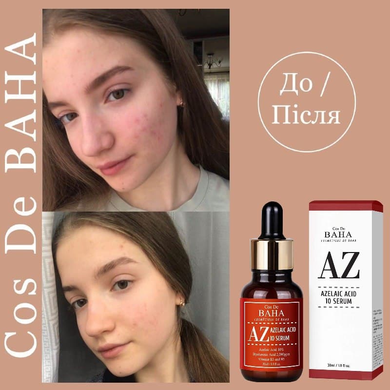 Azelaic Acid 10%