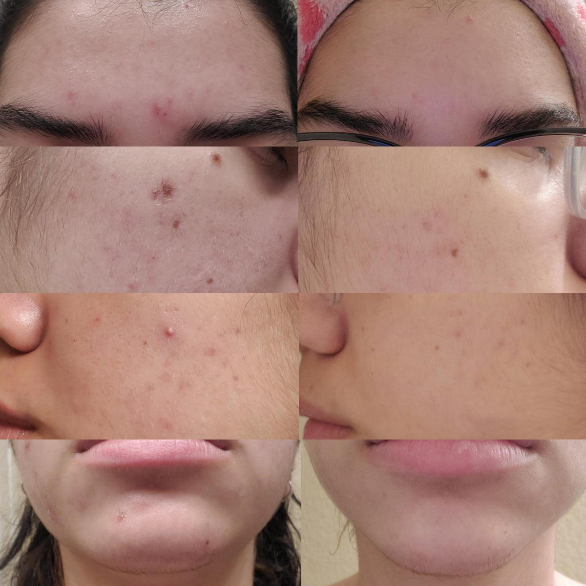 Azelaic Acid 10%